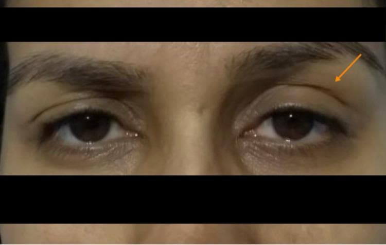 This clinical photograph displays a frontal view of a patient's eyes, highlighting diagnostic signs of Horner's syndrome. The image demonstrates a clear asymmetry between the left and right ocular regions. The left eye exhibits visible ptosis (drooping of the upper eyelid), indicated by an orange arrow, where the eyelid margin sits lower on the iris compared to the contralateral side. Furthermore, there is evidence of miosis (pupillary constriction) in the left eye, making the pupil appear significantly smaller than the right. The right eye appears normal with a baseline pupil size and expected eyelid position. Clinically, this presentation is characteristic of sympathetic nerve pathway disruption, which in this context followed the administration of neuraxial analgesia. The image serves as a high-quality educational example for identifying the ocular components of a partial Horner's syndrome in a clinical setting.