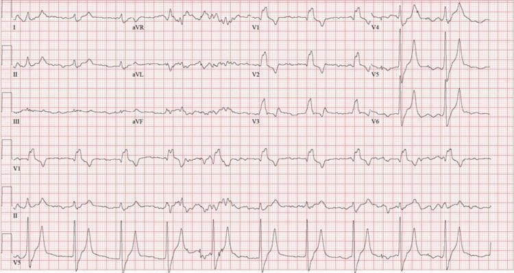 A 12-lead electrocardiogram (ECG) demonstrating several conduction abnormalities and metabolic-related changes. Key findings include a significantly widened QRS complex across all leads, exceeding 120 ms, consistent with a bundle branch block morphology; specifically, a right bundle branch block (RBBB) pattern is suggested by the RSR' morphology in V1. Additionally, the precordial leads, particularly V4 and V5, exhibit prominent, symmetrically peaked (tent-shaped) T waves, which are a characteristic visual indicator of hyperkalemia. The rhythm shows a prolonged PR interval, indicating a first-degree atrioventricular (AV) block. The tracing is presented on standard grid paper for the measurement of intervals and amplitudes. This ECG serves as a clinical teaching tool for identifying the cardiac manifestations of electrolyte imbalances (like high potassium levels) and concurrent intraventricular conduction delays.