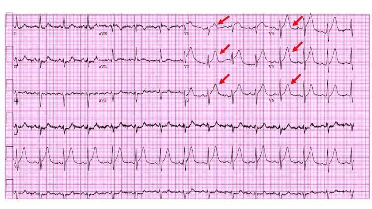 This diagnostic image is a 12-lead electrocardiogram (ECG) demonstrating the 'de Winter' T-wave pattern, a critical STEMI-equivalent signifying acute proximal left anterior descending (LAD) coronary artery occlusion. The primary findings are concentrated in the precordial leads (V1-V6), characterized by upsloping ST-segment depression at the J-point that transitions into tall, prominent, and symmetrical T-waves. Red arrows specifically highlight these hyperacute T-wave morphologies. In contrast, the limb leads (I, II, III, aVL, aVF) show relatively normal ST-T configurations, although lead aVR displays a minor ST-segment elevation (<0.5 mm). The ECG rhythm appears to be sinus tachycardia. This pattern is clinically significant as it indicates a high risk of extensive anterior wall myocardial infarction despite the absence of classic ST-elevation. This visual resource is essential for medical students and clinicians to recognize atypical presentations of acute coronary syndrome.