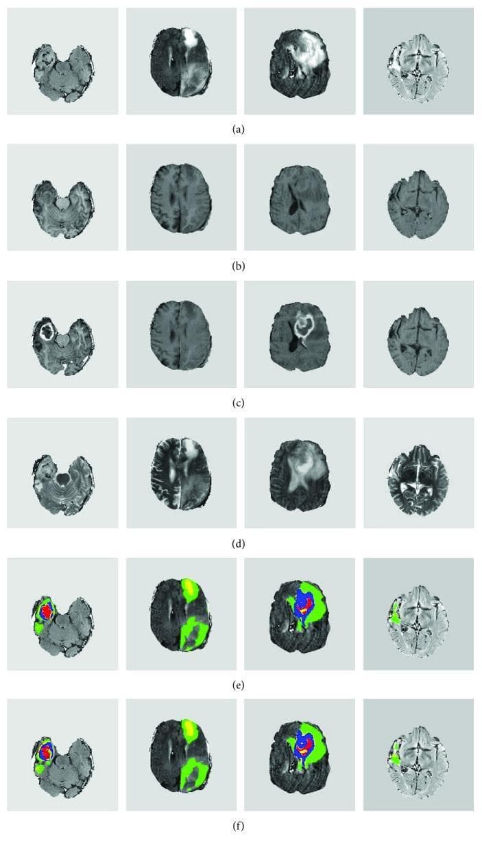 This diagnostic image displays a multi-row comparison of brain MRI sequences and automated tumor segmentation results for four clinical cases of glioma. Rows (a) through (d) illustrate axial slices in different imaging modalities: FLAIR (Fluid-Attenuated Inversion Recovery), T1-weighted, T1-weighted contrast-enhanced (T1c), and T2-weighted sequences. The FLAIR and T2 images highlight hyperintense areas corresponding to vasogenic edema and tumor bulk, while the T1c images reveal regions of blood-brain barrier disruption via gadolinium enhancement. Rows (e) and (f) present a comparison between the ground truth (expert manual segmentation) and computer-generated segmentation results, both overlaid on the FLAIR sequence. The segmentation utilizes a color-coded classification system to identify distinct intratumoral pathologies: red denotes necrosis (central core), green identifies peritumoral edema, yellow represents non-enhancing tumor tissue, and blue indicates the enhancing tumor components. The visualization demonstrates the clinical application of deep learning (FCN and CNN) in characterizing heterogeneous brain tumor subregions for neuro-oncological assessment and treatment planning.