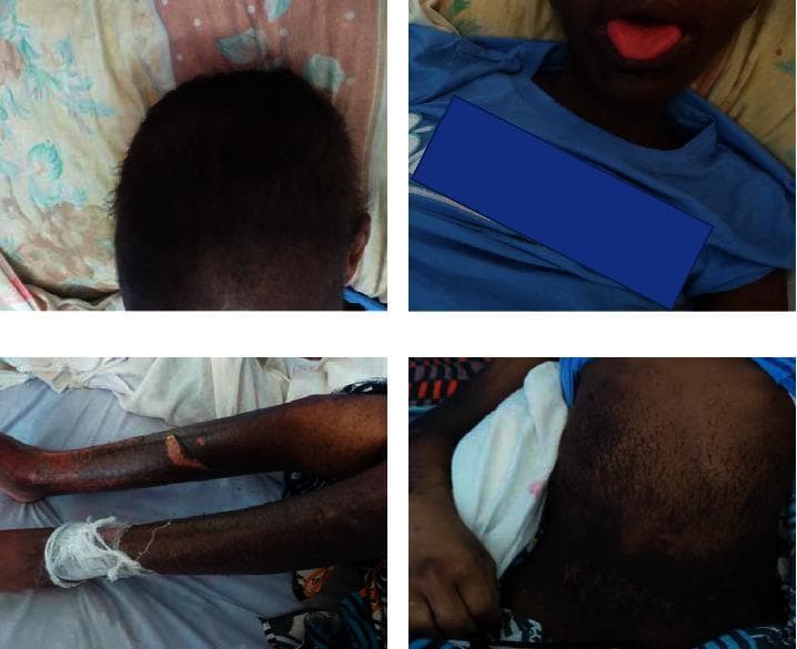 A composite of four clinical photographs demonstrating the systemic dermatological and mucosal manifestations of Acrodermatitis Enteropathica (AE) in a pediatric patient. The top-left panel shows the scalp with diffuse alopecia and dyspigmented, lightened hair. The top-right panel displays the orofacial region, highlighting beefy red glossitis of the tongue and perioral dermatitis. The bottom-left panel illustrates the lower extremities, featuring widespread hyperpigmented patches, skin erosions, and a prominent flaccid bulla on the shin, with one limb partially bandaged. The bottom-right panel depicts the abdomen, characterized by extensive hyperpigmentation and scattered erosive lesions. Collectively, these images illustrate the classic clinical triad of zinc deficiency: periorificial dermatitis, alopecia, and diarrhea-associated systemic skin breakdown. The presentation is essential for medical students and clinicians for the diagnostic recognition of nutritional deficiencies and zinc malabsorption syndromes.