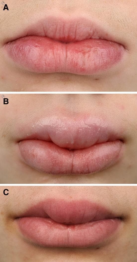 A series of three clinical photographs (a, b, and c) documenting the progression and treatment response of orofacial granulomatosis (cheilitis granulomatosa) in a pediatric patient. Photograph (a) shows the initial presentation with mild erythema and localized edema of the lower lip, displaying a dry texture and fine surface fissuring. Photograph (b) demonstrates a significant progression to macrocheilia, characterized by marked, diffuse swelling of both the upper and lower lips. The lip surfaces appear smooth, tense, and glossy, indicating severe interstitial edema. Photograph (c) depicts the clinical status after one year of combination therapy with infliximab and azathioprine. There is a visible reduction in swelling compared to (b), though mild persistent enlargement remains compared to the baseline in (a). The surface texture has regained normal anatomical creases and a matte appearance. This sequence serves as a clinical reference for the extraintestinal manifestations of Crohn's disease and the efficacy of biological maintenance therapy in managing orofacial granulomatosis.