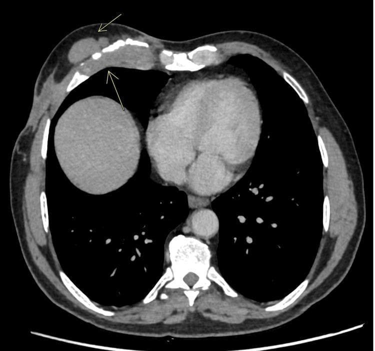 This diagnostic image is an axial contrast-enhanced computed tomography (CECT) scan of the thorax at the level of the lower chest and upper abdomen. The image demonstrates significant pathology of the anterior chest wall involving the right fifth costal cartilage. Key findings include a focal soft tissue mass and associated thickening at the costochondral junction. Evidence of bony erosion and fragmentation of the costal cartilage is visible, suggesting an aggressive inflammatory or infectious process, such as tubercular costochondritis. Additionally, multiple well-defined, ovoid soft tissue density nodules (indicated by arrows) are present within the subcutaneous tissues of the anterior abdominal and chest wall, which can be seen in conditions like neurofibromatosis or disseminated granulomatous disease. The internal anatomy shows the heart, descending aorta, and the superior aspect of the liver. This scan illustrates the radiological presentation of extrapulmonary tuberculosis manifesting as chest wall involvement with secondary subcutaneous nodules.