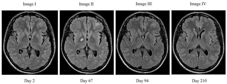 A comparison chart consisting of four axial Brain MRI images using Fluid-Attenuated Inversion Recovery (FLAIR) sequences, illustrating the longitudinal progression of intracranial lesions over a 210-day period. Image I (Day 2) serves as the baseline, showing no acute masses or focal signal abnormalities. Image II (Day 67) demonstrates two distinct hyperintense lesions: an 11 mm mass in the right corpus callosum/globus pallidus region and a separate lesion in the left frontal lobe. Image III (Day 94) shows significant interval regression of the right-sided mass (reduced to 4 mm), while the left frontal lesion (later identified as a meningioma) remains stable. Image IV (Day 210) reveals complete resolution of the right-sided hyperintensity, consistent with successfully treated cryptococcoma likely associated with Immune Reconstitution Inflammatory Syndrome (IRIS). The comparison highlights the differential radiological evolution between an infectious/inflammatory lesion (cryptococcoma) and a stable neoplastic lesion (meningioma) under antifungal and corticosteroid therapy. This diagnostic series is used to teach neuroradiological manifestations of opportunistic infections in HIV/AIDS patients and the monitoring of treatment response.