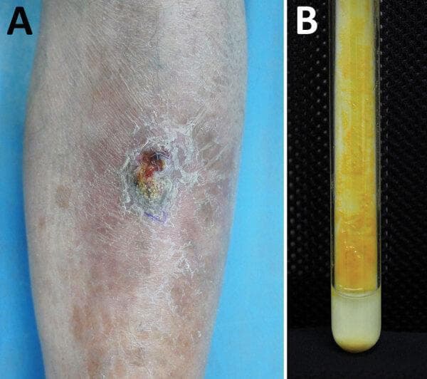 A composite image consisting of a clinical photograph and a laboratory culture diagnostic image illustrating a case of cutaneous mycobacterial infection. Panel A: Clinical photograph of the left shin of a 63-year-old male showing a solitary, well-circumscribed, dull red nodule. The lesion exhibits a verrucous (wart-like) surface texture with peripheral scaling and crusting, suggestive of chronic granulomatous inflammation. The surrounding skin shows mild erythematous and atrophic changes. Panel B: A diagnostic laboratory image showing a Löwenstein-Jensen (LJ) medium slant in a test tube. There is heavy growth of smooth, bright orange-pigmented colonies covering the surface of the slant. The scotochromogenic characteristic of the colonies, which produce pigment even in the absence of light, is a key diagnostic feature of certain non-tuberculous mycobacteria, such as the Mycobacterium gordonae complex. This visual sequence links physical clinical manifestations with microbiological confirmatory evidence.