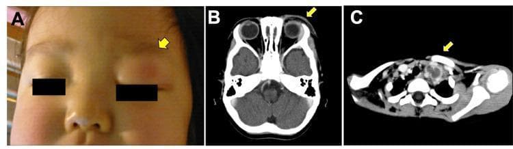 This composite medical image displays clinical and radiological findings in a pediatric patient. Figure A is a clinical photograph showing significant left supraorbital swelling and erythema (indicated by a yellow arrow) involving the left upper eyelid, initially suggestive of preseptal cellulitis. Figure B is an axial enhanced CT scan of the head at the orbital level, demonstrating thickening of the left supraorbital skin and irregular attenuation within the subcutaneous fatty tissue, though the orbital contents appear spared. Figure C is an axial enhanced CT scan of the lower neck/supraclavicular region, revealing a pathologically enlarged left supraclavicular lymph node with a characteristic low-density (hypodense) center, suggesting necrotic changes or metastatic involvement. These findings are pedagogically used to illustrate the clinical presentation of metastatic neuroblastoma, which can mimic inflammatory conditions like orbital cellulitis through orbital and lymph node spread.