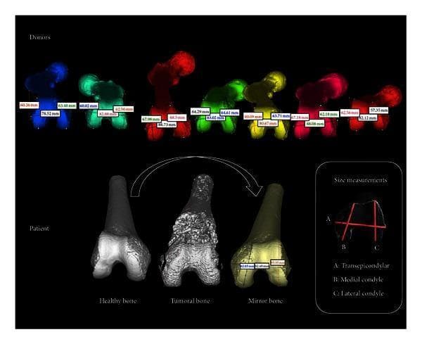 Educational diagram illustrating the preoperative planning for bone allograft selection using 3D modeling and morphometric matching. The top panel shows a donor bank of 3D-segmented distal femur models, each color-coded and annotated with specific anatomical measurements. The bottom panel displays three patient-specific distal femur models: 'Healthy bone' (contralateral side), 'Tumoral bone' showing pathological cortical irregularities and osteoblastic/osteolytic changes, and a 'Mirror bone' generated by reflecting the healthy side to simulate the original anatomy. A separate 'Size measurements' legend defines the three primary landmarks for matching: (A) Transepicondylar width, (B) Medial condyle anterior-posterior diameter, and (C) Lateral condyle anterior-posterior diameter. This visual summarizes the digital workflow for oncological orthopedic surgery, emphasizing the use of 3D registration and segmentation to achieve anatomical congruency between donor tissue and the host site.