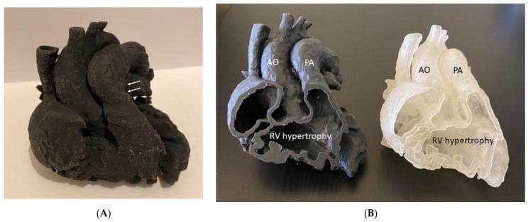 This educational image displays 3D-printed heart models used to demonstrate the complex anatomy of Tetralogy of Fallot (ToF). Panel A shows a monolithic, dark-colored model from an external perspective; white arrows point to the pulmonary artery, highlighting pulmonary artery stenosis. Panel B illustrates the same heart model printed in two sagittal halves using different material colors (opaque dark grey and translucent white). This cross-sectional view provides a detailed internal anatomical study of the four hallmark features of ToF: the overriding aorta (labeled AO), pulmonary artery stenosis (labeled PA), and significant right ventricular hypertrophy (labeled RV hypertrophy). The sectioned view allows for clear visualization of the thickened right ventricular myocardial wall and the spatial relationship between the great vessels and the ventricular chambers. These models serve as high-fidelity educational tools for surgical planning and understanding congenital heart disease (CHD) manifestations.