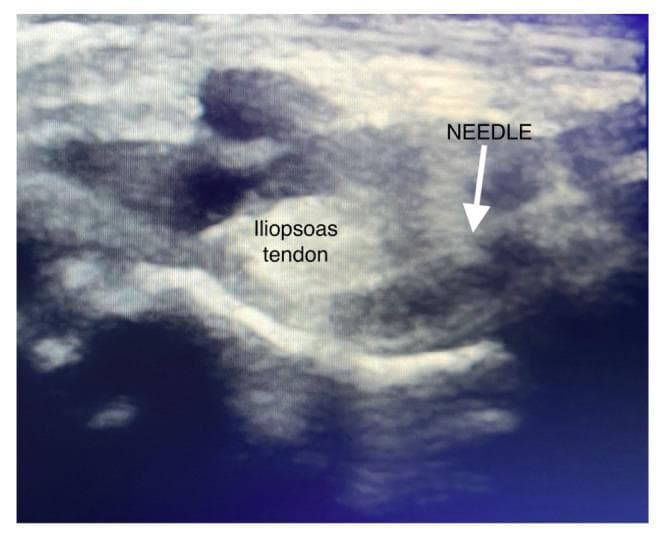 This diagnostic ultrasound image demonstrates the technique for a PENG (Pericapsular Nerve Group) block in the hip region. The image shows a transverse view of the pelvic anatomy, focusing on the space between the anterior inferior iliac spine (AIIS) and the iliopubic eminence. The iliopsoas tendon is clearly identified as a prominent, hyperechoic (bright), oval-shaped structure with a homogeneous internal texture. A needle tip is visualized and labeled, positioned laterally to the iliopsoas tendon. The needle path enters from a lateromedial direction to target the fascial plane beneath the tendon, adjacent to the bone surface of the ilium. This modified technique is intended for regional anesthesia to provide analgesia for hip fractures or surgeries while minimizing quadriceps motor weakness by depositing local anesthetic away from the femoral nerve.