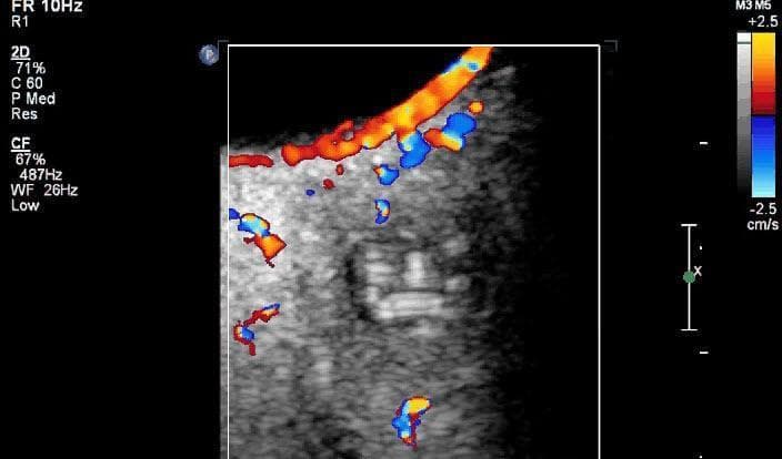 This diagnostic image is a Color Doppler ultrasound of the orbit, focused on a retroocular (retrobulbar) mass. The image displays a well-defined, heterogeneous grayscale nodule situated behind the globe. Color Doppler overlays demonstrate prominent vascular signals (represented by red and blue pixels indicating blood flow direction) along the periphery and within the capsule/wall of the lesion. In contrast, the internal core of the nodule is entirely devoid of color flow, confirming an avascular interior. Within this avascular space, subtle hyperechoic, coiled, or linear structures are visible, characteristic of a parasitic cystic lesion, such as Dirofilaria repens. The educational focus of this image is the use of Doppler sonography to differentiate between vascularized ocular tumors and avascular cystic masses containing non-vascularized structures like helminthic parasites. This imaging modality is crucial for surgical planning and diagnosing orbital dirofilariasis.