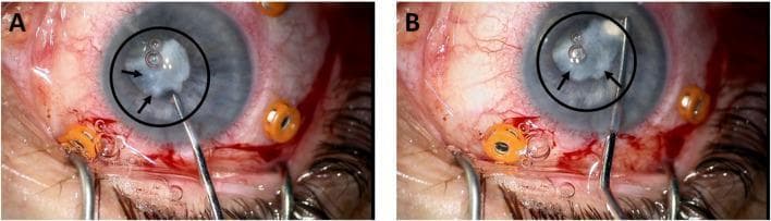 This image consists of two clinical photographs (A and B) showing the intraoperative removal of a grade 3 cataract from a human eye. The photographs display a high-magnification view of the anterior segment during surgery. In both frames, the central lens is visibly opacified, exhibiting a cloudy, white, and non-transparent appearance characteristic of advanced lenticular sclerosis. A black circle and black arrows highlight the primary area of dense opacification. Fine surgical instruments, including a slender metal probe or phacoemulsification tip, are shown entering the anterior chamber to manipulate the lens material. Small air bubbles are visible on the lens surface and within the surgical field. The surrounding anatomy shows a dilated pupil, conjunctival injection with visible surgical bleeding, and several orange-colored trocars or fixation devices positioned around the sclera to stabilize the eye or provide ports for vitrectomy instruments. This clinical visual demonstrates the morphology of high-grade cataracts and the micro-surgical environment required for extraction.