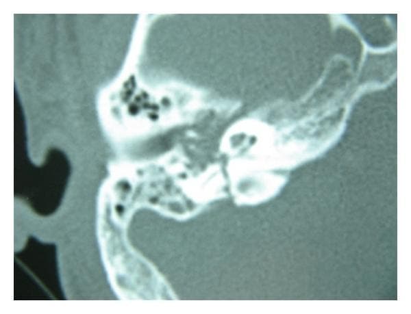 This diagnostic image is a high-resolution axial computerized tomography (CT) scan of the right temporal bone, focused on the petrous and mastoid segments. The scan demonstrates the complex anatomy of the auditory apparatus, including the mastoid air cells (visible as low-density, air-filled honeycomb structures), the external auditory canal, and the middle ear cavity. A sharp, hypodense linear lucency is clearly visible traversing the midportion of the vertical segment of the temporal bone, representing a transverse temporal bone fracture. This fracture line disrupts the high-density cortical bone and is oriented perpendicular to the long axis of the petrous pyramid. Such imaging is critical in evaluating traumatic head injuries, particularly when assessing for risks to the facial nerve canal or potential ossicular chain disruption. This material is suitable for advanced medical education in radiology, otolaryngology, and emergency medicine, illustrating the hallmark radiographic features of temporal bone trauma.