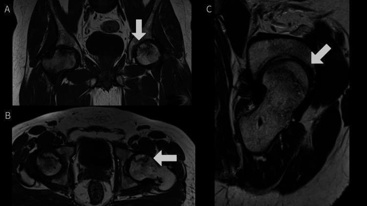 This composite of three Magnetic Resonance Imaging (MRI) scans—comprising coronal (A), axial (B), and sagittal (C) views—demonstrates bilateral avascular necrosis (AVN) of the femoral heads at varying stages. The right femoral head (indicated by white arrows) exhibits features consistent with Grade 3 AVN, characterized by significant low-signal intensity (sclerosis) in the weight-bearing region, subchondral collapse, and subtle flattening of the articular contour. In contrast, the left femoral head demonstrates Grade 2 AVN, showing focal areas of marrow signal alteration and a well-defined 'double-line sign' or sclerotic rim, but with a relatively preserved spherical shape and no evidence of articular surface depression. These images illustrate the radiological progression of osteonecrosis of the hip, highlighting the transition from early marrow edema and focal lesions to mechanical subchondral failure. The series serves as an educational tool for differentiating Ficat and Arlet or Steinberg stages of femoral head necrosis using multi-planar cross-sectional imaging.