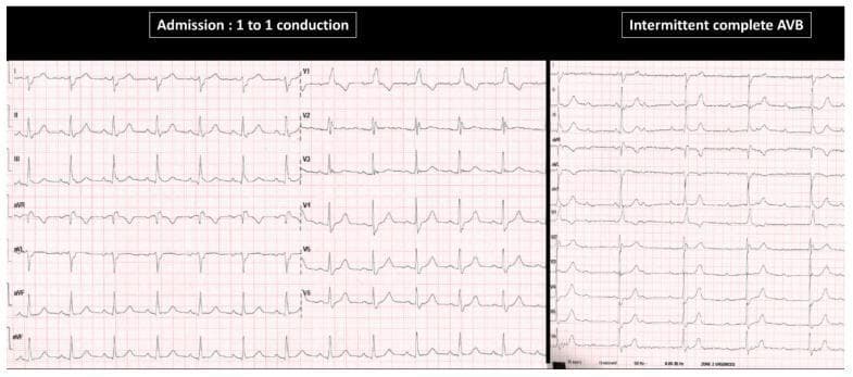 This Comparison Chart displays two 12-lead electrocardiogram (ECG) segments from an 82-year-old patient with syncope. The left panel, labeled 'Admission: 1 to 1 conduction', shows sinus rhythm with a fixed PR interval. The QRS morphology indicates bifascicular block, characterized by a Right Bundle Branch Block (RBBB) pattern (rsR' in V1) and a Left Posterior Fascicular Block (LPFB) evidenced by right axis deviation. The right panel, labeled 'Intermittent complete AVB', demonstrates an episode of third-degree atrioventricular block (AVB). In this section, P waves are clearly visible and regular (sinus rate), but they are dissociated from the ventricular activity, with multiple non-conducted P waves and a prolonged ventricular pause (asystole). This visual comparison illustrates the progression from chronic infra-nodal conduction disease to paroxysmal complete heart block. The educational focus is on identifying AV dissociation and pre-existing bundle branch abnormalities as precursors to high-grade atrioventricular block.