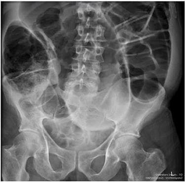 This abdominal X-ray (supine anteroposterior projection) demonstrates significant pathology of the large bowel. The primary finding is a massively dilated loop of the sigmoid colon, presenting the classic 'coffee bean sign' (also known as the Frimann-Dahl sign). The dilated loop originates from the pelvis and extends into the upper abdominal quadrants, characterized by smooth, hairless walls and a thick central white line representing the opposed medial walls of the twisted sigmoid loop. The bowel gas pattern reveals a transition from the pelvic girdle toward the mid-abdomen, where the distended loop displaces other abdominal viscera. Anatomical landmarks including the lumbar spine, sacrum, and iliac crests are visible, although partly obscured by the overlying gaseous distension. This radiographic appearance is pathognomonic for sigmoid volvulus, a form of large bowel obstruction caused by torsion of the sigmoid colon around its mesenteric axis. The image serves as a key educational example for identifying acute abdominal emergencies and differentiating sigmoid from cecal volvulus based on bowel loop morphology and orientation.