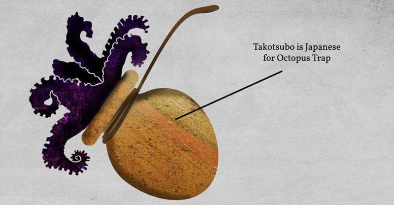 This educational illustration serves as an etymological and morphological reference for Takotsubo cardiomyopathy (also known as stress-induced cardiomyopathy or broken heart syndrome). The image features a stylized representation of a traditional Japanese 'takotsubo' (octopus trap), consisting of an earthen ceramic pot with a rounded base and a narrow neck. A dark purple octopus is shown entering or exiting the narrow opening, emphasizing the vessel's shape. This visual is historically significant in cardiology as it illustrates the striking physical resemblance between the pot and the apical ballooning of the left ventricle typically observed during the systolic phase in patients with this condition. During an acute episode, apical akinesis or hypokinesis coupled with basal hyperkinesis causes the left ventricle to assume this flask-like configuration on a ventriculogram. The image includes text annotation stating, 'Takotsubo is Japanese for Octopus Trap,' facilitating student understanding of the nomenclature used to describe this transient cardiac syndrome.