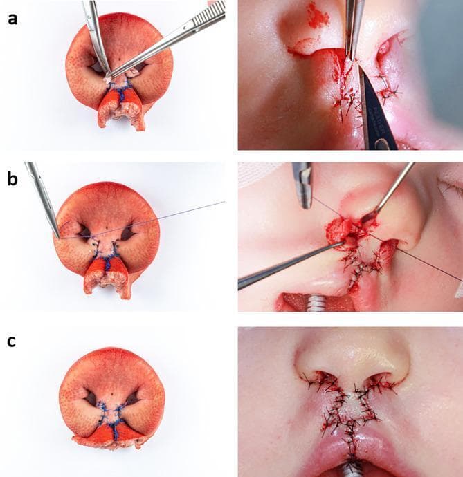 A comparative series of six clinical photographs and ex vivo model images illustrating the final stages of the Millard bilateral cleft lip repair (rotation-advancement technique). The left column displays a porcine snout disc ex vivo model, while the right column shows the corresponding intraoperative stages in a human infant. Row (a) demonstrates the excision of the 'parking flaps' (c-flaps) using surgical forceps and a scalpel when columellar lengthening is not required. Row (b) depicts the suture of the nasal entrance and sill construction (cphs points) using absorbable Vicryl 4-0 sutures to define the nasal base. Row (c) shows the final skin closure and aesthetic result, featuring the reconstruction of the Cupid's bow and prolabium using non-absorbable Ethilon 4-0 sutures. The comparison highlights the use of the porcine model for surgical simulation, mimicking the anatomical landmarks, tissue layers, and suturing pathways essential for plastic and reconstructive surgery training in congenital craniofacial malformations.