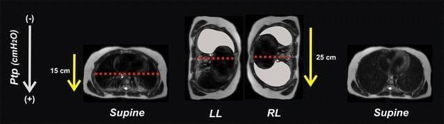 This sequence of cross-sectional thoracic CT images illustrates the concept of a postural lung recruitment maneuver in a pediatric patient. The visualization shows four anatomical states: initial Supine, Left Lateral (LL), Right Lateral (RL), and final Supine. In the supine position, the thorax is elliptical with a horizontal orientation; a red dotted line demarcates a lower lung zone predisposed to atelectasis. Transitioning to lateral positions (LL and RL) reorients the thoracic dimensions, increasing the gravity-dependent vertical distance. Yellow arrows with values (15 cm in supine vs. 25 cm in lateral) represent the trans-pulmonary pressure (Ptp) gradient. In LL, the non-dependent right lung is shown as an aerated gray schematic, indicating recruitment. In RL, the previously dependent left lung is now non-dependent and recruited. The final supine image demonstrates bilateral lung aeration, illustrating how sequential positioning can eliminate atelectasis and maintain an 'open lung' state by utilizing gravity-dependent changes in thoracic geometry and pleural pressure gradients.