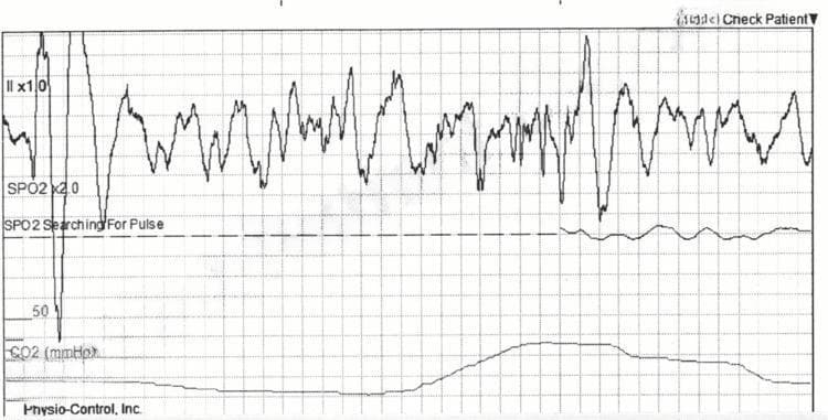 This diagnostic image shows a multi-parameter monitor strip capturing a critical cardiac event. The top tracing (Lead II x1.0) demonstrates a classic Ventricular Fibrillation (VF) pattern, characterized by a chaotic, disorganized, and erratic rhythm with varying amplitudes and frequencies. There are no identifiable P waves, QRS complexes, or T waves, representing the absence of coordinated ventricular depolarization. Below the ECG, the SpO2 plethysmography channel (SpO2 x2.0) initially shows a significant artifact followed by a flatline with a 'Searching For Pulse' status indicator, consistent with a loss of mechanical output and perfusion during VF. The bottom tracing displays capnography (CO2 mmHg), showing a low, relatively flat waveform that suggests minimal to absent ventilation or circulation during the arrest. The image serves as a clinical illustration of sudden cardiac arrest and the associated loss of physiological monitoring signals. The visual data is critical for training in Advanced Cardiac Life Support (ACLS), emphasizing the immediate need for defibrillation.