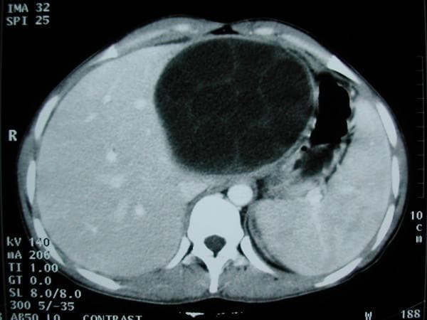 This diagnostic image is an axial contrast-enhanced computed tomography (CT) scan of the upper abdomen demonstrating a large, multilocular hepatic cyst. The primary lesion is a well-defined, hypo-attenuating (fluid-density) spherical mass located within the left lobe of the liver, specifically involving segments II, III, and IV. The cyst displays a classic 'multivesicular' appearance, characterized by multiple internal septations and smaller peripheral daughter cysts within the parent cyst, which is highly suggestive of a WHO Type CE2 or CE3a hepatic hydatid cyst caused by Echinococcus granulosus. The mass measures approximately 11 cm in diameter, resulting in a significant mass effect that displaces the surrounding liver parenchyma and causes mild compression of the adjacent stomach and splenic structures. Other visible anatomical landmarks include the right lobe of the liver, the spleen, the stomach containing air, and the vertebral body. This image is an essential educational example for parasitology and abdominal radiology, illustrating the classic diagnostic features used to differentiate hydatid disease from simple hepatic cysts or abscesses.