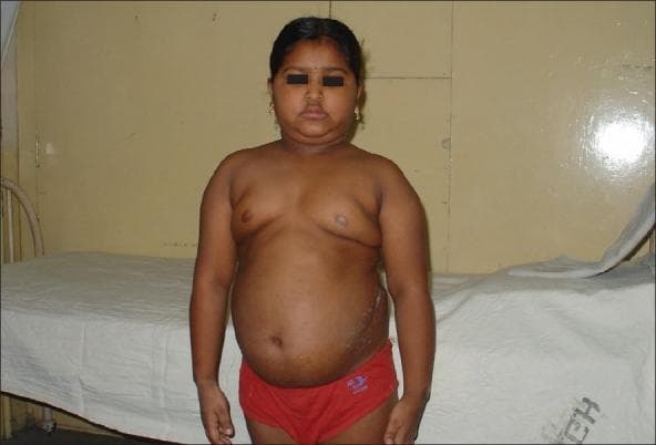 This clinical photograph shows a pediatric patient presenting with characteristic physical features of Cushing syndrome. The face exhibits a rounded, 'moon facies' appearance with associated submental fat deposition (double chin). There is evidence of central adiposity with a protuberant abdomen and fullness in the supraclavicular and upper chest regions, consistent with truncal obesity. A visible dorsocervical fat pad, or 'buffalo hump', is present at the base of the neck. On the patient's left flank, a linear surgical scar is visible, indicating a prior operative intervention. These findings are visually representative of hypercortisolism, which in this case is associated with an ACTH-secreting ganglioneuroma. The image serves as an educational example for identifying the systemic manifestations of glucocorticoid excess in children.