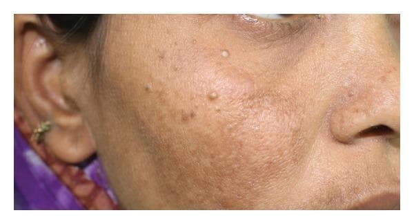 This clinical photograph displays a close-up view of the right mid-face, focusing on the malar region and nose. The image demonstrates multiple facial trichilemmomas, which present as small, discrete, flat-topped papules. These lesions range in size from approximately 1 to 5 mm in diameter. The distribution is clustered over the right malar bone, with additional smaller papules visible on the nasal ala. While most papules are skin-colored, several prominent lesions exhibit a paler, translucent, or pearly white appearance. The surrounding skin shows secondary features including fine textural irregularities and areas of hyperpigmentation (melasma-like patches). This visual is representative of the dermatological manifestations of Cowden syndrome, where multiple facial trichilemmomas serve as a key diagnostic indicator. The image is intended for medical education in dermatology and genetics to aid in the recognition of benign follicular neoplasia and its systemic associations.