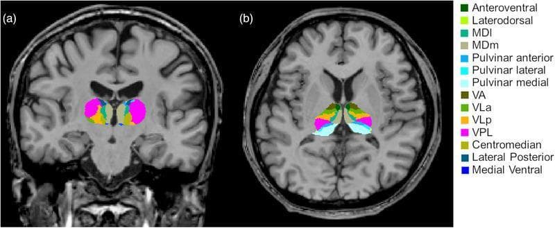 Diagnostic neuroimaging featuring automated segmentation of thalamic nuclei in a patient with epilepsy. The figure displays T1-weighted MRI scans in the coronal (a) and axial (b) planes, with color-coded overlays identifying specific thalamic subregions. Key segmented nuclei include the Ventral Posterolateral (VPL, magenta), Ventral Lateral posterior (VLp, orange), Ventral Lateral anterior (VLa, light green), and Ventral Anterior (VA, dark green) nuclei. The medial groups, including the Mediodorsal lateral parvocellular (MDl) and Mediodorsal medial magnocellular (MDm) nuclei, are positioned near the midline. In the axial view, the posterior Pulvinar complex (anterior, lateral, and medial) is clearly demarcated. The image demonstrates the internal structural organization of the thalamus, highlighting the spatial relationships and morphological boundaries of individual nuclei within the diencephalon. This visualization is characteristic of neuroimaging post-processing used for volumetric analysis in clinical research and surgical planning for neurological disorders such as epilepsy.