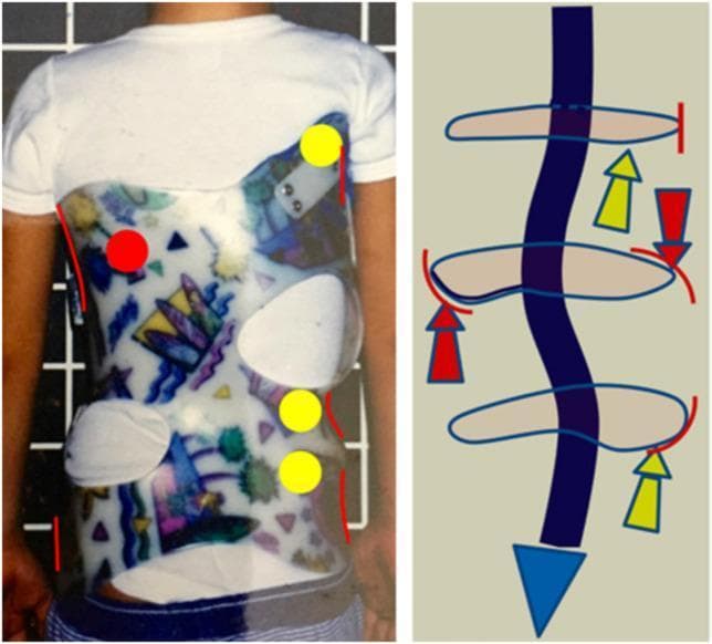 This composite educational graphic illustrates the design and biomechanical principles of a 3D corrective brace (based on Rigo principles) for early-onset single thoracic scoliosis. The left panel shows a clinical photograph of a pediatric patient wearing a rigid thoracic-lumbar-sacral orthosis (TLSO). The brace features specific expansion voids and pressure areas, including a regional derotation zone (marked with a red circle) and counter-rotation points (marked with yellow circles). The right panel provides a corresponding biomechanical diagram of the vertebral column with a left-convex thoracic curve. Large red arrows indicate the primary regional derotation mechanism acting at the apical region of the main curve, while yellow arrows demonstrate cranial (superior) and caudal (inferior) counter-rotation forces. The diagram highlights lateral, dorsal, and ventral contacts designed to optimize frontal and sagittal plane alignment. This visual demonstrates the multi-planar corrective strategy used in orthotic management to achieve spinal balance and prevent the progression of compensatory curvatures in scoliosis patients.