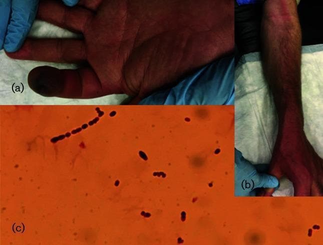 This composite image consists of three panels demonstrating clinical and microbiological findings of a severe bacterial infection. Panel (a) is a clinical photograph of a patient's hand showing a swollen, necrotic left index fingertip with distinct dark, gangrenous discoloration. Panel (b) shows the patient's forearm with visible erythematous linear streaking extending proximally, characteristic of lymphangitis. Panel (c) is a high-power light microscopy image of a Gram-stained sample, revealing numerous Gram-positive cocci. The organisms are round in morphology and predominantly arranged in long chains, which is a classic feature of Streptococcus species. Together, these images illustrate the progression from a localized soft tissue infection (such as digital necrosis or paronychia) to lymphatic involvement and the identification of the causative chain-forming Gram-positive pathogen, often associated with Streptococcus pyogenes.