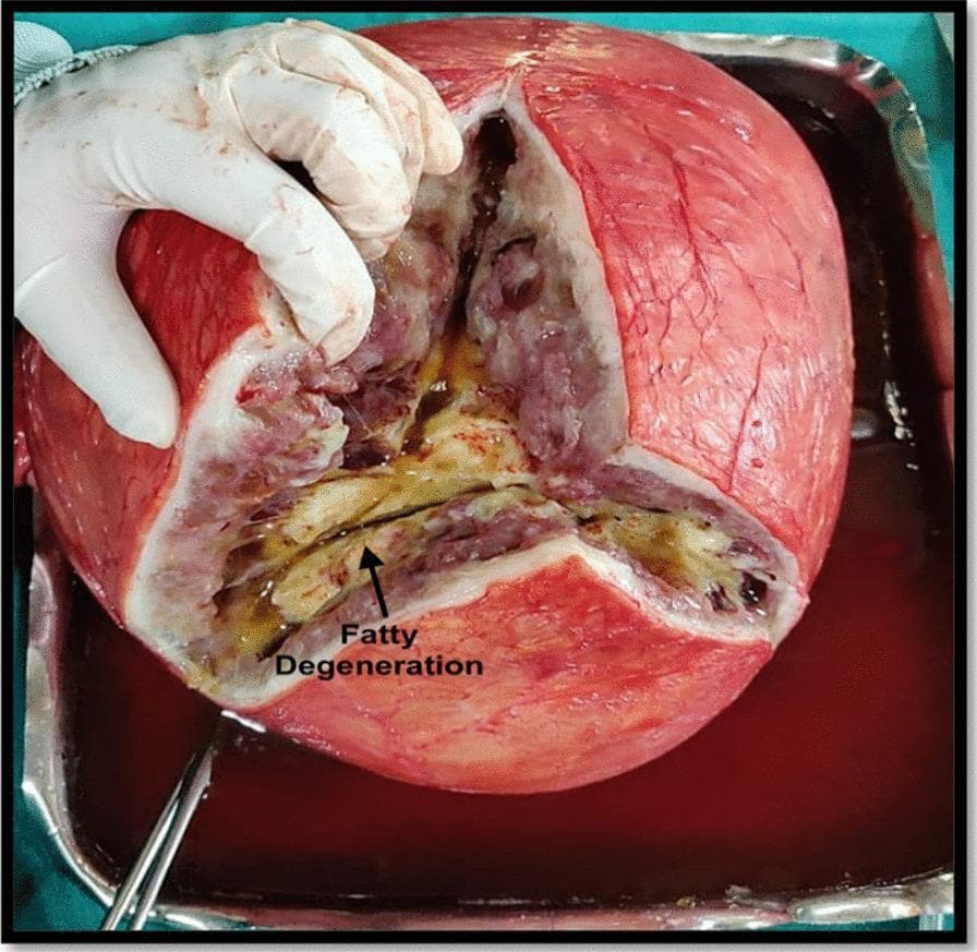 This clinical photograph shows a gross pathological specimen of a large uterine leiomyoma (fibroid) following a total abdominal hysterectomy. The specimen is presented in a surgical tray, with a gloved hand retracting a deep Y-shaped incision to reveal the internal structure. The external surface of the mass is reddish-pink with visible vascularity. The cut section demonstrates a heterogeneous internal composition characteristic of secondary degeneration in a benign smooth muscle tumor. A central region, marked by an arrow and labeled 'Fatty Degeneration,' exhibits a distinct yellowish, oily, and somewhat greasy appearance. This area is surrounded by mottled reddish-brown, off-white, and greyish tissue, with some darker regions suggestive of hemorrhagic or cystic changes. This visual is an educational example of macroscopic degenerative changes in chronic uterine leiomyomas, illustrating the loss of the typical whorled appearance and its replacement by fibro-fatty tissue. It is relevant for pathology and gynecology learners studying benign uterine neoplasms and their potential for massive enlargement and structural transformation.