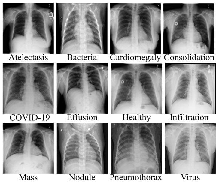This diagnostic image is a comparison chart consisting of a 3x4 grid of posteroanterior (PA) chest x-ray (CXR) radiographs, each labeled with a specific clinical finding or diagnosis. The collection serves as a visual guide for thoracic pathology in adult and pediatric patients. Conditions depicted include Atelectasis (linear opacities), Bacterial Pneumonia (localized consolidation), Cardiomegaly (enlarged cardiac silhouette), and Consolidation. The second row demonstrates COVID-19 (bilateral patchy opacities), Pleural Effusion (blunting of the costophrenic angle), a Healthy chest for baseline comparison, and Infiltration. The final row shows Mass, Nodule (small focal opacity), Pneumothorax (characterized by hyperlucency, absence of lung markings, and a visible pleural line indicating lung collapse), and Viral Pneumonia (diffuse, interstitial infiltrates). The educational focus is on differentiating between normal pulmonary anatomy and various respiratory pathologies based on radiodensity, distribution of opacities, and anatomical distortion, making it a valuable tool for radiology training and computer-aided diagnosis (CAD) classification tasks.
