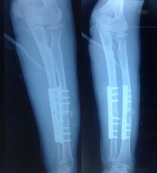 This diagnostic imaging consists of two postoperative X-ray views (anteroposterior and lateral) of a human forearm. The image demonstrates surgical internal fixation of both the radius and ulna. Two dynamic compression plates (DCP) are visible, secured to the mid-diaphyseal regions of both bones using multiple bicortical screws. A visible osteotomy or fracture gap is present in the mid-shaft of the radius, where the plate serves to maintain alignment and stability. The proximal radioulnar joint and the elbow joint appear well-aligned, and the distal radio-carpal joint is partially visible. The internal hardware is positioned to address a forearm deformity or non-union, facilitating bone healing through rigid internal fixation. This image is medically significant for orthopaedic education regarding the surgical management of diaphyseal forearm fractures or corrective osteotomies using plating techniques.