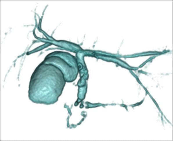 This diagnostic image is a 3D reconstruction from Magnetic Resonance Cholangiopancreatography (MRCP) showing the biliary and pancreatic duct systems. The gallbladder is visualized as a distended, lobulated sac-like structure connected to the biliary tree. The intrahepatic bile ducts appear as a branching network draining into the common bile duct. A significant anatomical variant is demonstrated where the main pancreatic duct forms an annular configuration, encircling the projected location of the second portion of the duodenum. A distinct filling defect is visible within the pancreatic duct at the level of the pancreatic head, likely representing a pancreatic calculus. Distal to this obstruction, the pancreatic duct shows mild compensatory dilatation. The image is clinically relevant for diagnosing congenital anomalies such as annular pancreas and associated complications like obstructive pancreatolithiasis or pancreaticobiliary maljunction.