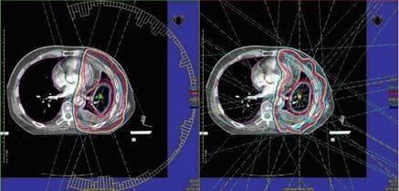 Diagnostic axial CT slices of the thorax comparing radiation treatment planning techniques: Volumetric Modulated Arc Therapy (VMAT) on the left and Intensity-Modulated Radiation Therapy (IMRT) on the right. The images display dose distributions around a Planning Target Volume (PTV) in the left lung. The VMAT plan (left) demonstrates superior dose conformity, with tight, smooth isodose lines closely encompassing the target and a semi-circular arc indicating continuous gantry rotation. The IMRT plan (right) shows discrete, static beam paths intersecting at various angles, resulting in less uniform isodose surfaces and a more irregular dose distribution profile around the PTV. Key educational concepts illustrated include the Comparison of dose homogeneity and the Conformity Index between static-field and rotational radiotherapy delivery methods. The visualization highlights the sparing of surrounding Organs at Risk (OARs), such as the heart and contralateral lung, through optimized beam modulation.