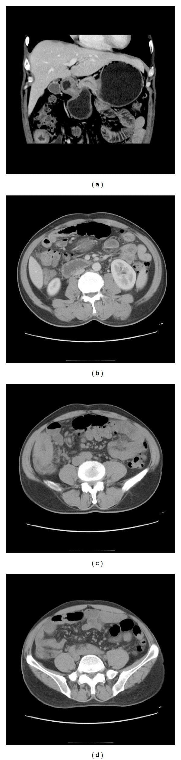 This composite of abdominal Computed Tomography (CT) images, including coronal (a) and axial (b-d) views, demonstrates classic radiographic findings associated with inflammatory bowel disease, specifically Crohn's disease. The primary anatomical focus is the terminal ileum, which exhibits significant small-bowel wall thickening and severe segmental narrowing of the intestinal lumen, often referred to as the 'string sign'. The mucosal surface of the affected ileal segment shows a 'cobblestone appearance,' representing alternating areas of deep ulceration and intramural edema. Associated mesenteric features include mesenteric adenopathy, characterized by enlarged, rounded lymph nodes within the surrounding fat. These diagnostic features illustrate chronic transmural inflammation and are clinically significant for identifying intestinal stenosis and potential fistulization in a gastroenterological context. The images serve as an educational resource for medical students and radiology residents to recognize the complications of chronic granulomatous inflammation in the gastrointestinal tract.