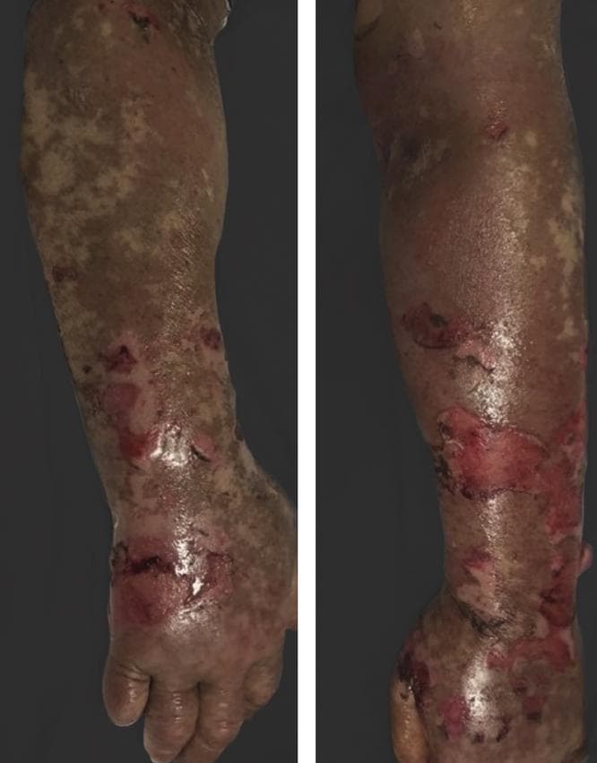 This clinical photograph displays a side-by-side view of an individual's upper extremity, demonstrating severe cutaneous pathology consistent with Toxic Epidermal Necrolysis (TEN). The image illustrates diffuse epidermal detachment and widespread erosions across the forearm, wrist, and dorsal hand. Visible features include large, irregular areas of denuded skin exposing the bright red, moist dermis, indicating significant loss of the epidermal layer. Surrounding the primary erosions, the skin shows evidence of confluent erythema, ruptured bullae (blisters), and mottled pigmentation changes with patches of dusky gray and tan discoloration. This presentation highlights a critical dermatological emergency often associated with drug-induced hypersensitivity reactions—in this specific context, potentially triggered by tyrosine kinase inhibitor therapy (vandetanib) following UV exposure. The visual findings serve as a classic representation of severe skin sloughing and full-thickness epidermal necrosis for educational use in dermatology and emergency medicine.
