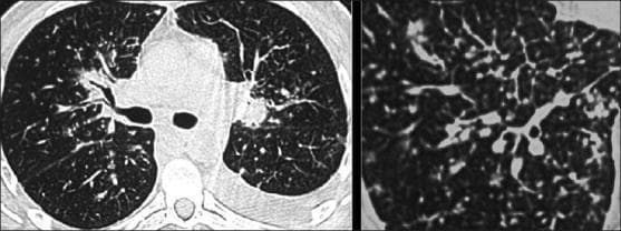 This diagnostic image consists of high-resolution computed tomography (HRCT) axial slices of the chest at the level of the carina, alongside a magnified view of the lung parenchyma. The imaging demonstrates classic features of pulmonary Kaposi sarcoma. Key visual findings include prominent thickening of the bronchovascular bundles, reflecting a bronchocentric distribution of disease. There is also evident smooth and nodular thickening of the interlobular septa, characteristic of lymphatic obstruction and lymphangitic spread related to tumor invasion. These septal lines create a distinct pattern that outlines the secondary pulmonary lobules. The perihilar regions show confluent soft tissue opacities extending along the airways. Such HRCT findings are clinically significant for differentiating Kaposi sarcoma from other opportunistic infections, like Pneumocystis jirovecii pneumonia, particularly in the context of advanced HIV/AIDS. The target audience includes radiology residents and infectious disease specialists focusing on pulmonary manifestations of immunosuppression.
