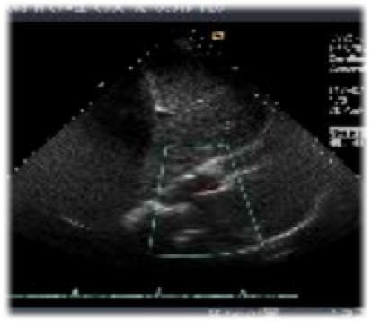 Transthoracic echocardiogram (TTE) in a grayscale B-mode view with overlaid color Doppler, demonstrating a mural thrombus within the left ventricle. The ventricular chamber is roughly conical with speckled, hyperechoic borders representing the myocardium. At the left ventricular apex, a focal, echogenic mass is visible, consistent with a mural thrombus. The thrombus appears as a region of similar or slightly increased echogenicity compared to the adjacent cardiac wall, with somewhat poorly defined margins. A central rectangular Color Doppler gate shows red signals, indicating blood flow velocity directed toward the ultrasound transducer. This diagnostic image highlights a common complication of myocardial infarction, where localized wall motion abnormalities (hypokinesis) facilitate stasis and subsequent thrombus formation, posing a significant risk for systemic thromboembolic events such as cerebral infarction.