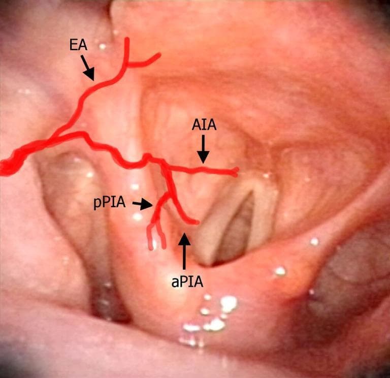 This clinical photograph displays a laryngeal videoendoscopy, simulating a transoral surgical perspective of the human larynx. The image features a healthy, pinkish-red mucosal surface with anatomical landmarks including the epiglottis, arytenoids, and vocal folds. Superimposed schematic red lines illustrate the branching patterns of the laryngeal arteries. The epiglottic artery (EA) originates superiorly, branching downward. The antero-inferior artery (AIA) follows a horizontal course across the paraglottic space. The postero-inferior artery bifurcates into the anterior branch (aPIA), which descends vertically toward the vocal process and paraglottic space, and the posterior branch (pPIA), which is situated lateral and posterior to the arytenoid. This educational graphic serves to demonstrate the surgical vascular anatomy relevant to transoral laryngeal procedures, highlighting the relationship between major arterial branches and endolaryngeal structures.
