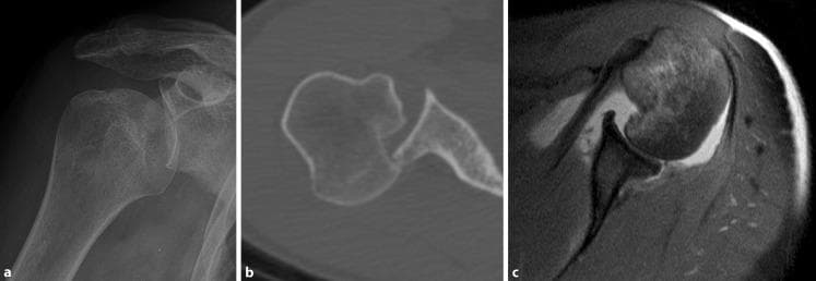 This composite diagnostic image illustrates the radiological findings of an acute locked posterior shoulder dislocation and its subsequent reduction across three modalities. (a) An anteroposterior shoulder X-ray demonstrates an abnormal glenohumeral relationship, often characterized by the 'light bulb sign' due to internal rotation of the humeral head. (b) An axial CT scan reveals a clear posterior dislocation where the humeral head is displaced behind the glenoid fossa. A prominent impaction fracture on the anterior aspect of the humeral head, known as a 'reverse Hill-Sachs defect' or 'McLaughlin lesion,' is visible. (c) An axial T2-weighted MRI scan shows the joint following reduction. The humeral head is realigned with the glenoid, but diagnostic markers remain, including the persistent humeral head impaction and a posterior Bankart lesion (avulsion of the posterior labrum). These images provide educational value in identifying the bony and soft tissue sequelae of posterior glenohumeral instability, categorized under the ABC classification for shoulder injuries.