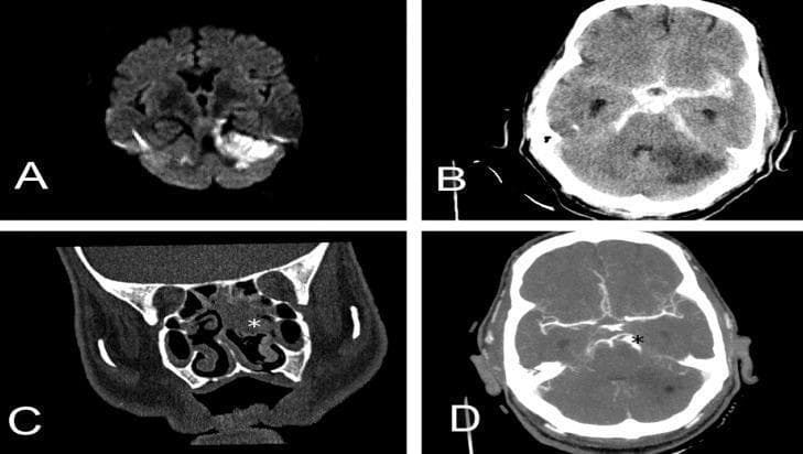 This composite of diagnostic imaging illustrates various neurovascular and otorhinolaryngological pathologies across multiple modalities. Panel A: Axial diffusion-weighted magnetic resonance imaging (DWI MRI) demonstrating hyperintensity in the left cerebellar hemisphere, consistent with restricted diffusion in acute ischemic infarction. Panel B: Non-contrast axial head CT showing diffuse hyperdensity within the basal cisterns and sulci, characteristic of extensive subarachnoid hemorrhage (SAH), alongside a hypodense region in the cerebellum representing secondary ischemic stroke. Panel C: Coronal CT scan of the paranasal sinuses revealing opacification of the nasal cavity and ethmoid cells (marked with a white star), indicating an inflammatory or infectious process such as sinusitis. Panel D: Axial brain CT angiography (CTA) showing vascular morphology, specifically highlighting two consecutive fusiform aneurysms localized in the superior cerebellar artery (marked with a black star). The set provides a comprehensive visual comparison of acute stroke, intracranial hemorrhage, infectious sequelae, and vascular malformations for medical education in radiology and neurology.