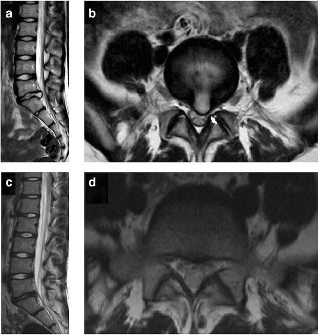 This diagnostic image set consists of four T2-weighted magnetic resonance imaging (MRI) scans of the lumbar spine, providing a pre- and post-operative comparison of a lumbar disc herniation. Images (a) and (b) represent the preoperative state. The sagittal view (a) shows a posterior disc protrusion at the L5-S1 level, narrowing the spinal canal. The corresponding axial view (b) demonstrates a significant left-sided paramedian disc herniation (indicated by a white arrow) causing clear compression of the exiting nerve root and displacement of the thecal sac. Images (c) and (d) show the same patient six months following surgical decompression. The postoperative sagittal view (c) illustrates restored spinal canal patency at L5-S1. The postoperative axial view (d) confirms the complete removal of the herniated disc material, showing a decompressed nerve root and restored epidural space. This comparison is an educational example of degenerative disc disease and the efficacy of surgical intervention in relieving mechanical neural compression.
