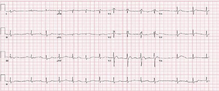 A standard 12-lead diagnostic electrocardiogram (ECG) printed on grid paper, demonstrating key clinical features of cardiac glycoside toxicity. The tracing shows a sinus rhythm with a prolonged PR interval, indicative of a first-degree atrioventricular (AV) block. There is widespread, persistent ST-segment depression, most prominent in the precordial leads (V1 through V6), characterized by a down-sloping morphology often described as the 'digoxin effect.' Associated with this depression are biphasic T-waves across multiple leads. These findings represent a transition from a higher-degree heart block to a more stable conduction pattern following the administration of digoxin immune fab. The educational focus of this image is the recognition of ECG changes associated with cardiotoxic glycosides (e.g., Cerbera odollam or digoxin) and the assessment of treatment response in a clinical toxicology or emergency medicine context.