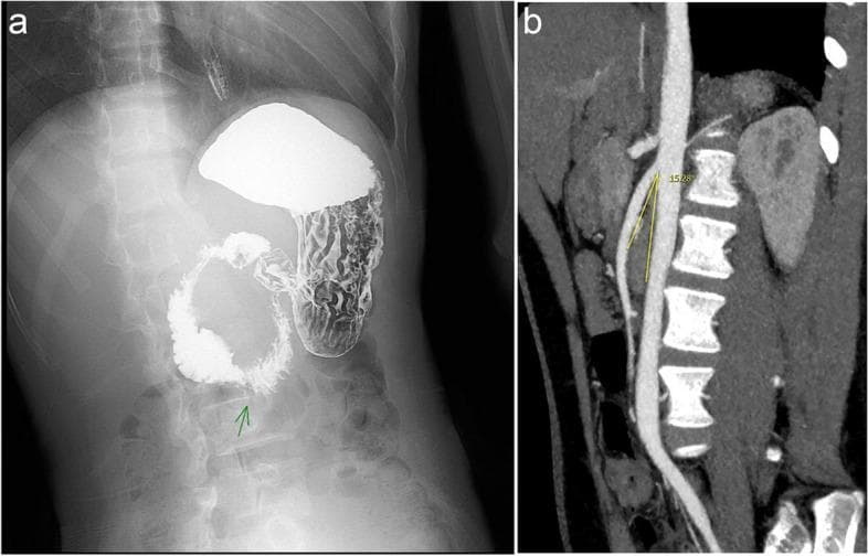 This composite diagnostic image illustrates the radiological findings of Superior Mesenteric Artery Syndrome (SMAS). Panel a presents an abdominal X-ray from a barium meal study, showing significant gastric distension and dilation of the first and second portions of the duodenum. A characteristic abrupt narrowing is visible at the third duodenal portion (indicated by a green arrow), known as the 'penholder sign,' representing extrinsic compression. Panel b shows a sagittal CT angiography (CTA) reconstruction of the abdominal aorta and the superior mesenteric artery (SMA). Annotated yellow lines measure the aortomesenteric angle at 15.28 degrees, which is significantly below the normal range (typically 25-60 degrees). This reduced angle demonstrates the mechanical compression of the duodenum as it passes between the SMA and the aorta. These imaging modalities collectively demonstrate the classic diagnostic criteria for SMAS: proximal duodenal obstruction and a narrowed vascular angle.
