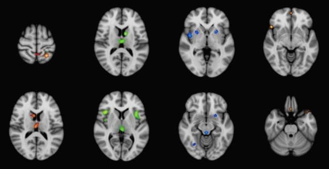 Diagnostic neuroimaging figure presenting a series of axial T1-weighted brain slices in MNI-152 template space. The visualization uses anatomic likelihood estimation (ALE) meta-analysis results to map significant gray matter atrophy patterns across four neurodegenerative movement disorders, distinguished by color-coded overlays. Corticobasal degeneration (CBD), shown in red, demonstrates atrophy primarily in the parietal lobes. Progressive supranuclear palsy (PSP), shown in green, highlights significant volume loss in the medial thalamus, insula, and midbrain. Multisystem atrophy Parkinson-type (MSA-P), represented in blue, shows localized atrophy within the putamen and brainstem structures. Idiopathic Parkinson's disease (IPD), indicated in gold/orange, shows scattered involvement including the frontal cortex. The comparison illustrates the differential spatial distribution of cortical and subcortical gray matter loss that characterizes these parkinsonian syndromes, providing educational value for differentiating atypical parkinsonian disorders from IPD based on structural MRI findings.