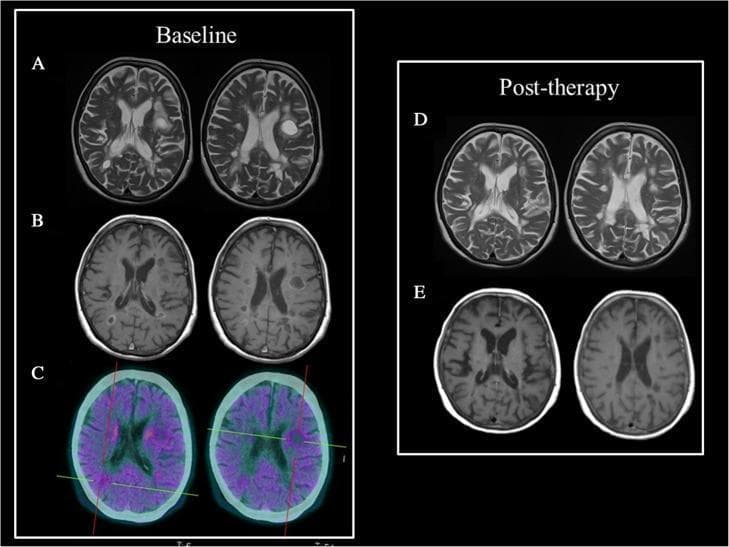 This composite of clinical diagnostic images presents a longitudinal comparison between baseline and post-therapy states of multifocal brain lesions in a patient with suspected tumefactive multiple sclerosis (TMS) or breast cancer metastasis.