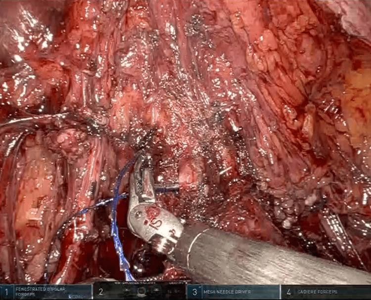 An intraoperative clinical photograph captured during a robotic-assisted gynecological procedure, specifically a radical hysterectomy. The image illustrates the preparation of the vaginal cuff for closure. Centrally, robotic surgical instruments, including a Mega Needle Driver and Fenestrated Bipolar Forceps marked with 'IS' branding, are manipulating a blue, monofilament, barbed suture (Stratafix). The suture is being passed through the anterior and lateral vaginal walls to create a circular purse-string suture. The surgical field displays moist, hyperemic pelvic tissues with visible dissection planes within the vesicovaginal and rectovaginal septa. The educational focus of the image is on the technique of intracorporeal vaginal cuff closure using knotless, absorbable barbed suturing in a minimally invasive robotic surgery context. This visual demonstrates key steps in pelvic surgery, emphasizing instrument handling, tissue traction, and the application of advanced suture materials for secure closure.