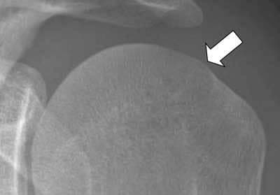 This diagnostic image is a conventional plain film radiograph (X-ray) of the human shoulder, specifically focusing on the humeral head. The image demonstrates a close-up view of the proximal humerus and its articulation with the glenoid. A prominent white arrow points to a localized bony protuberance on the postero-superior aspect of the humeral head. This finding represents a variation of a Hill-Sachs lesion, which is typically a compression fracture or depression following an anterior shoulder dislocation. In this specific case, the lesion appears paradoxically as an 'osteophyte-like' outward projection rather than a cortical indentation. This visual phenomenon occurs when the X-ray beam is tangent to the elevated, hypertrophic margin of the bony defect. The image illustrates a critical diagnostic pitfall in musculoskeletal radiology, where the morphology of a Hill-Sachs lesion can be misinterpreted based on the radiographic projection. The internal trabecular pattern and cortical density of the humeral head are well-preserved, highlighting the focal nature of the contour abnormality at the postero-superior head-neck junction.
