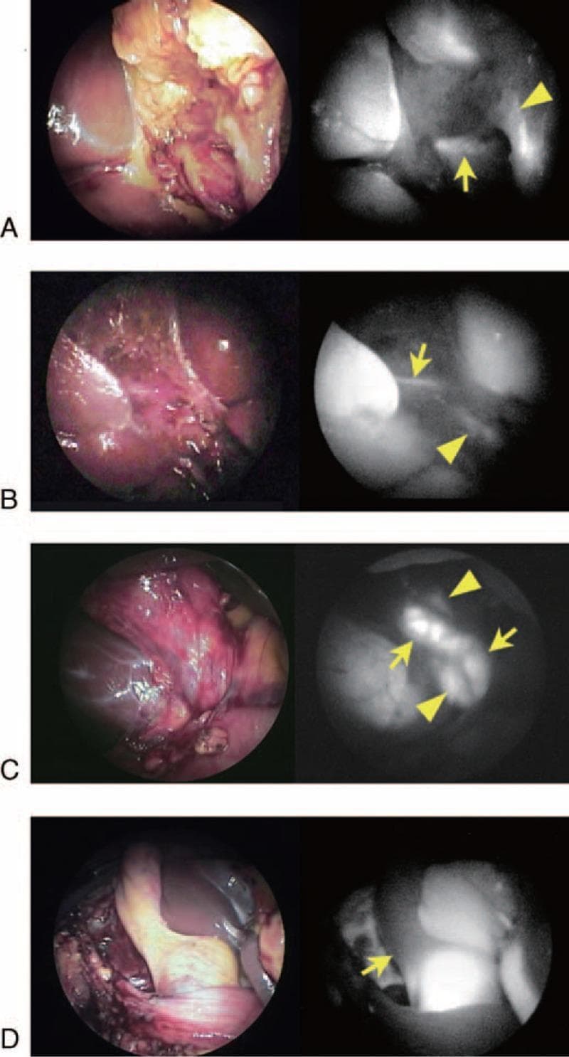 This medical image displays four pairs of laparoscopic views (A–D) comparing standard white-light endoscopy with indocyanine green (ICG) fluorescence cholangiography (FC) for intraoperative bile duct identification. (A) Shows an accessory hepatic duct (arrow) draining the right lateral liver sector into the common hepatic duct (arrowhead) near Rouviere's sulcus after dissection of Calot's triangle. (B) Illustrates a thin hepatic duct (arrow) running along the gallbladder bed, likely draining Couinaud's segment V, with the common hepatic duct marked by an arrowhead. (C) Visualizes the cystic duct (arrows) draining into the common hepatic duct (arrowheads) from the left side before Calot's triangle dissection, demonstrating spiral-type anatomy. (D) Highlights a fluorescence defect (arrow) within the cystic duct, indicating the presence of impacted gallstones. The series demonstrates the clinical utility of FC in mapping biliary variants and identifying pathology like cholecystolithiasis during laparoscopic cholecystectomy, enhancing the 'critical view of safety' by delineating extrahepatic biliary structures.