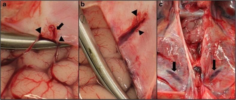 This composite of macroscopic clinical photographs demonstrates the venous anatomy of the human brain and dura mater during a forensic or surgical dissection. Panel A shows two bridging veins (arrowheads) draining from the frontal lobe gyri and converging into a parasagittal sinus (arrow), located approximately 3 cm distal to the superior sagittal sinus (SSS). Panel B displays the same region after the bridging veins have been severed and the dura reflected; arrowheads indicate the ostia where the veins previously entered the venous channel. Panel C focuses on the posterior fossa, highlighting tentorial sinuses (arrows) embedded within the dural folds overlying the cerebellar hemispheres. The images illustrate the complex drainage pathways of the cerebral and cerebellar convexities into dural venous structures. Key educational concepts include the identification of bridging veins, which are clinically significant in the pathogenesis of subdural hematomas, and the visualization of smaller dural venous channels distinct from the primary dural sinuses.
